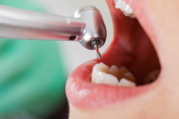 Best Emergency Wisdom Tooth Extraction in Lockport Heights, LA